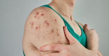 primer caso importado de sarampión